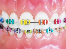 braces colors